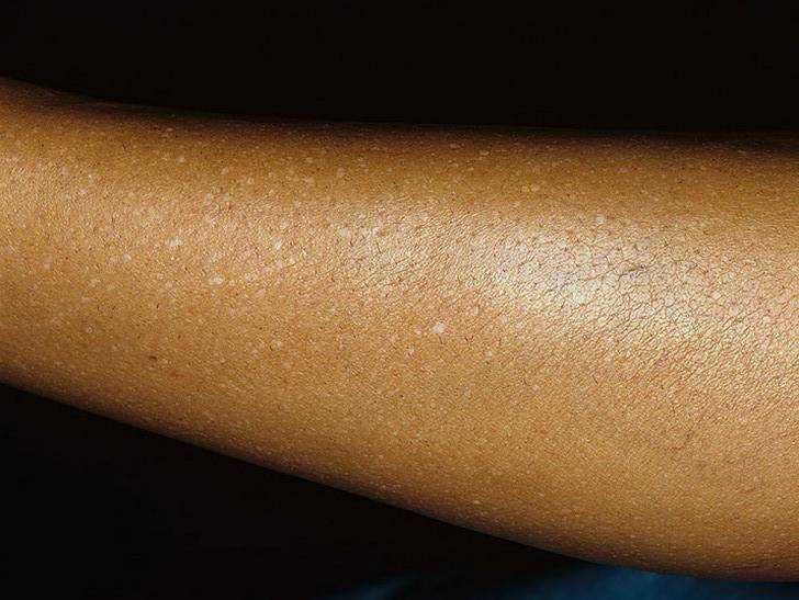 Белые пятна на коже: причины возникновения и эффективное лечение