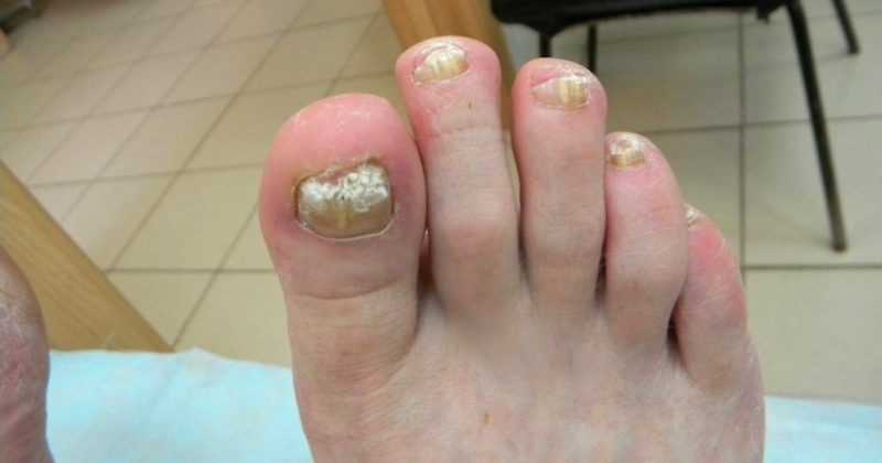 Как распознать грибок на ногах
